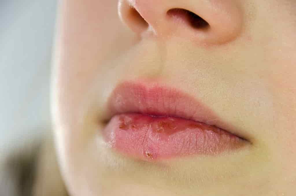 Treatment for chapped lips and nose